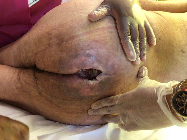 Stage 4 sacral pressure ulcer Day 1