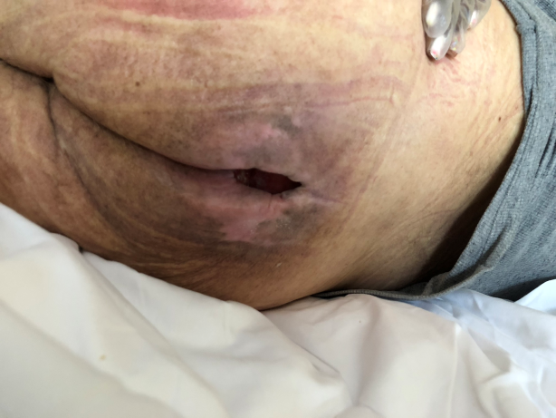 Stage 4 sacral pressure ulcer Day 45